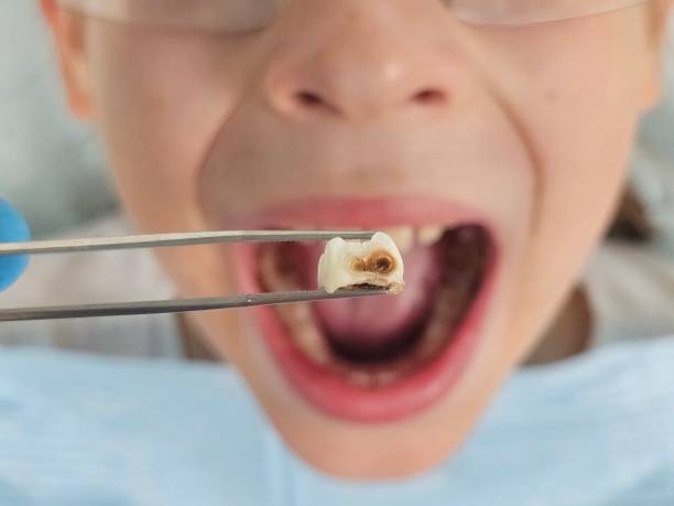 Best Emergency Broken Tooth Repair in Pine Lakes, FL